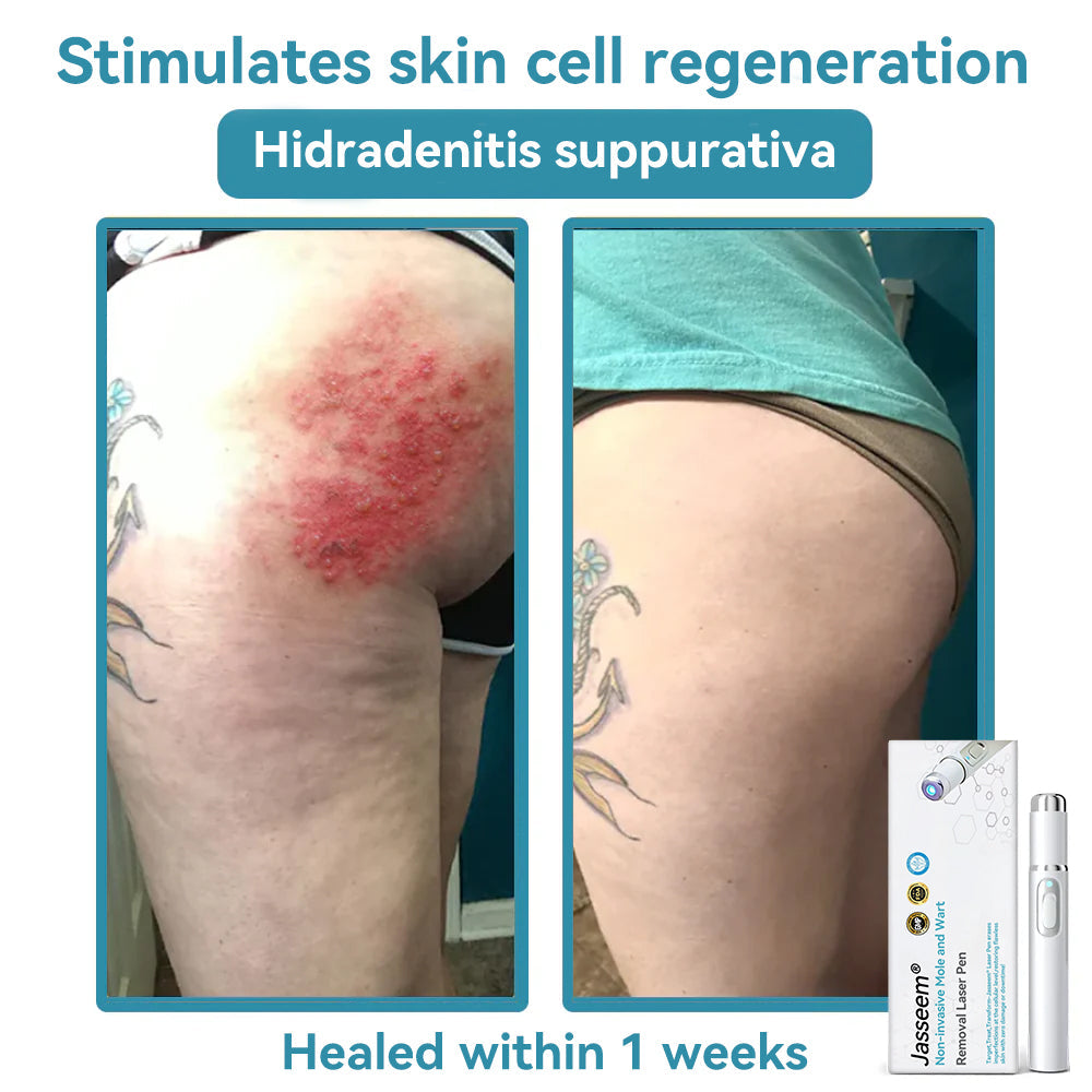 ๐๐๐ฌ๐ฌ๐๐๐ฆยฎ Medical-Grade Laser Pen ๐ (Powered by COโ laser technology โ effectively removes moles, warts, skin tags, pigmentation spots, and other skin imperfections)
