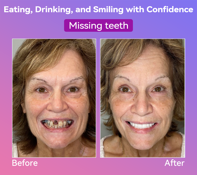 𝐉𝐚𝐬𝐬𝐞𝐞𝐦® Latest Premium Comfort Dentures🏆 (High-End Dentures, Easy to Wear - Limited Time 70% Discount)🔥