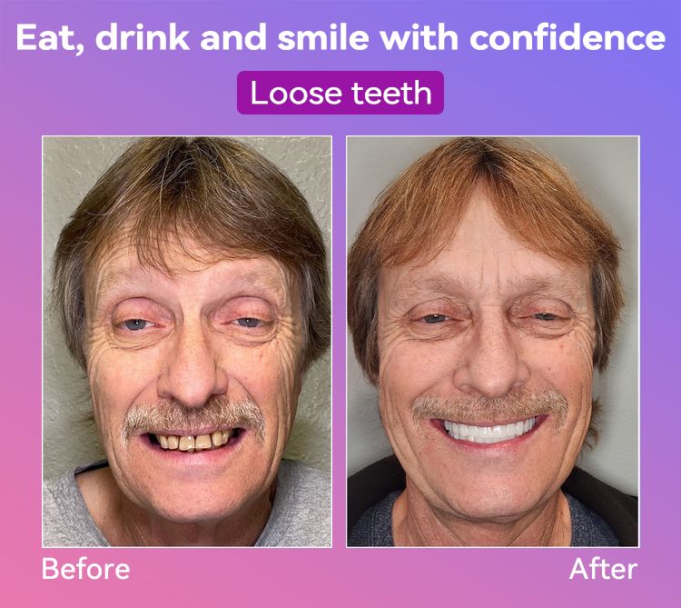 𝐉𝐚𝐬𝐬𝐞𝐞𝐦® Latest Premium Comfort Dentures🏆 (High-End Dentures, Easy to Wear - Limited Time 70% Discount)🔥