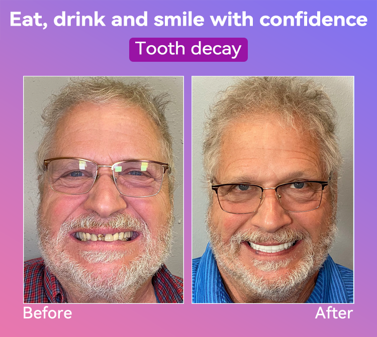𝐉𝐚𝐬𝐬𝐞𝐞𝐦® Latest Premium Comfort Dentures🏆 (High-End Dentures, Easy to Wear - Limited Time 70% Discount)🔥