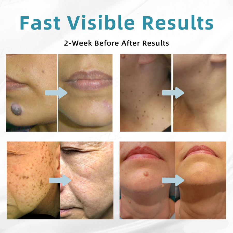 𝐉𝐚𝐬𝐬𝐞𝐞𝐦® Medical-Grade Laser Pen 🚚 (Powered by CO₂ laser technology – effectively removes moles, warts, skin tags, pigmentation spots, and other skin imperfections)