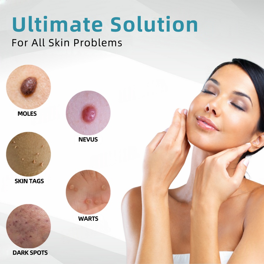 𝐉𝐚𝐬𝐬𝐞𝐞𝐦® Medical-Grade Laser Pen 🚚 (Powered by CO₂ laser technology – effectively removes moles, warts, skin tags, pigmentation spots, and other skin imperfections)