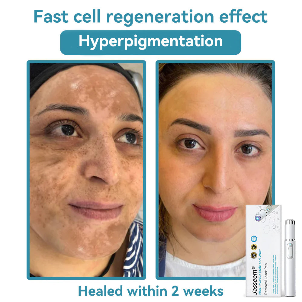 𝐉𝐚𝐬𝐬𝐞𝐞𝐦® Medical-Grade Laser Pen 🚚 (Powered by CO₂ laser technology – effectively removes moles, warts, skin tags, pigmentation spots, and other skin imperfections)