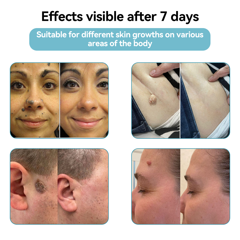 𝐉𝐚𝐬𝐬𝐞𝐞𝐦® Medical-Grade Laser Pen 🚚 (Powered by CO₂ laser technology – effectively removes moles, warts, skin tags, pigmentation spots, and other skin imperfections)