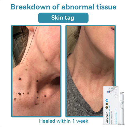 𝐉𝐚𝐬𝐬𝐞𝐞𝐦® Medical-Grade Laser Pen 🚚 (Powered by CO₂ laser technology – effectively removes moles, warts, skin tags, pigmentation spots, and other skin imperfections)