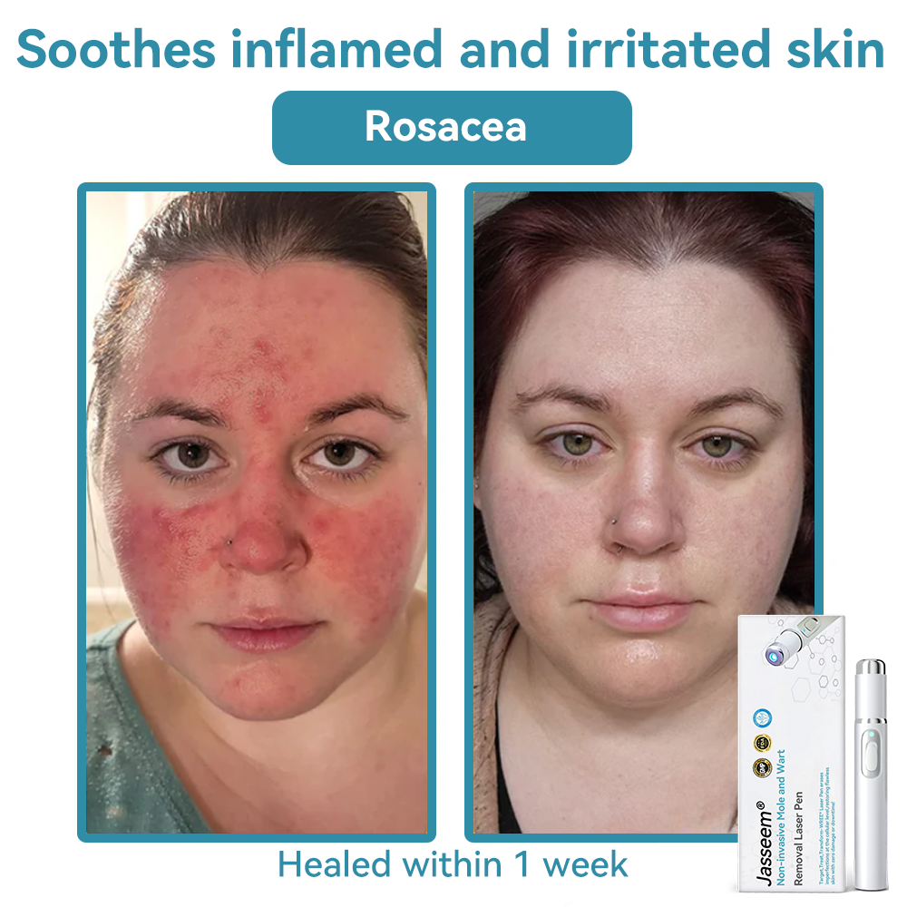 𝐉𝐚𝐬𝐬𝐞𝐞𝐦® Medical-Grade Laser Pen 🚚 (Powered by CO₂ laser technology – effectively removes moles, warts, skin tags, pigmentation spots, and other skin imperfections)